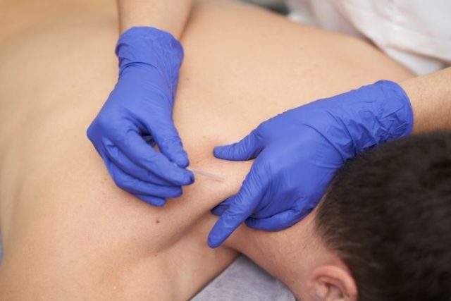 Acupuncture vs Dry Needling: What’s the Difference?
